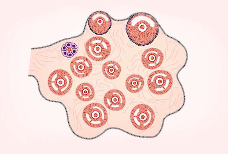 Treatment of Polycystic Ovary Syndrome (PCOS)