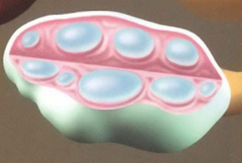 Polycystic ovary syndrome (PCOS).