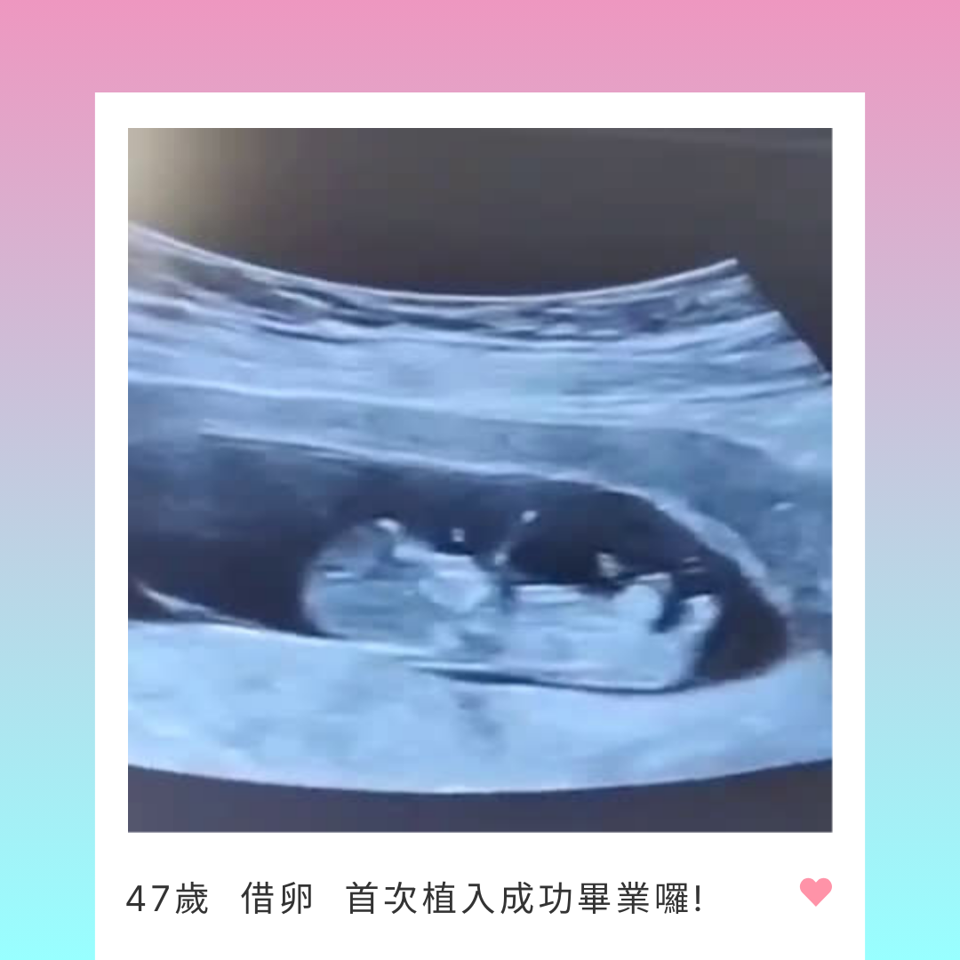 【AN-AN KAIYUAN】A 47-year-old wife from Shanghai came to Taiwan for egg donation and successfully got pregnant on the first embryo transfer!
