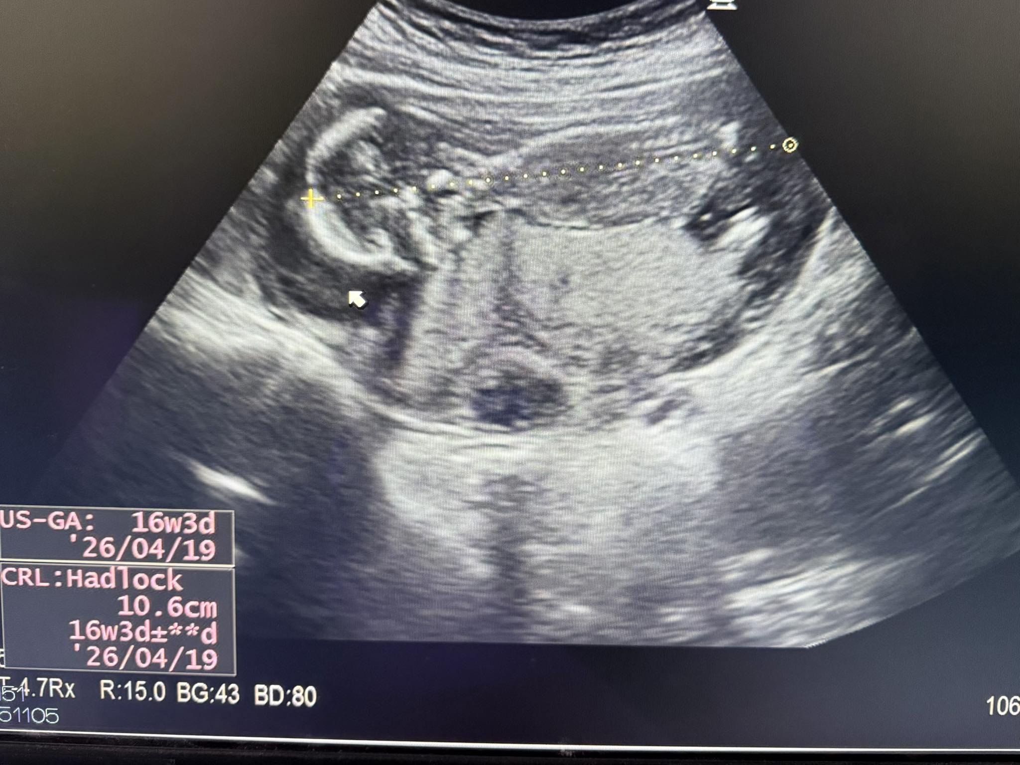 AMH極低＝沒希望懷孕嗎？ 